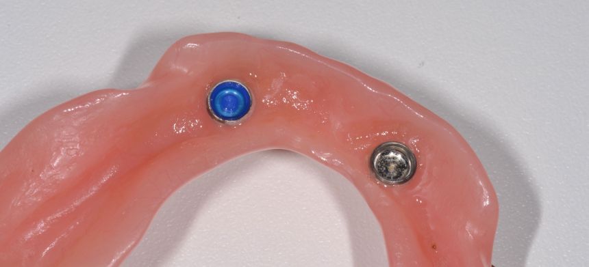 Proteza s ležištem locatora (desno) i plastičnom matricom ugrađenom u ležište (lijevo)