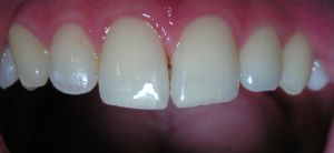 Zaljepljeni fragment